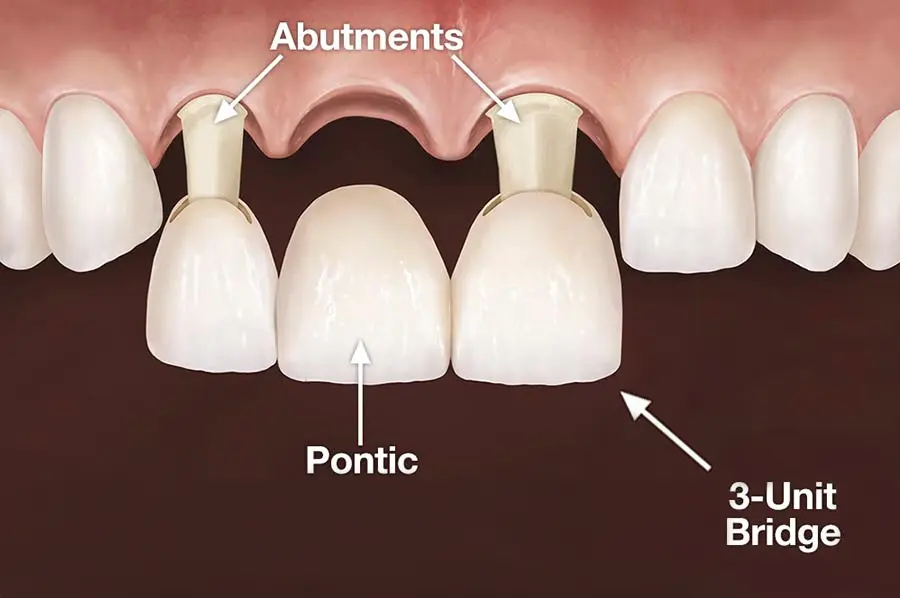 Dental Bridge