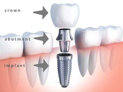 Dental Implant parts